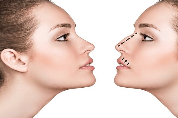 Korekcja nosa Wilmed