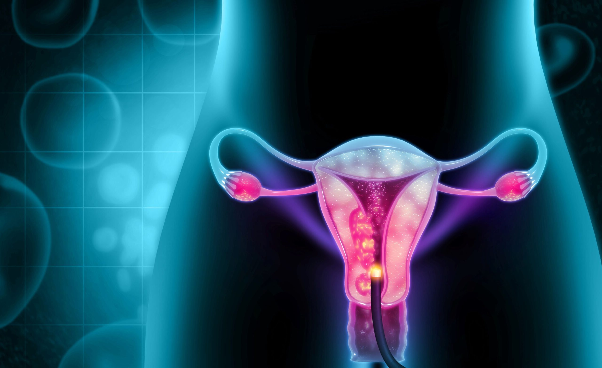 Histeroskopia i resektoskopia – zabiegowe leczenie zmian jamy macicy