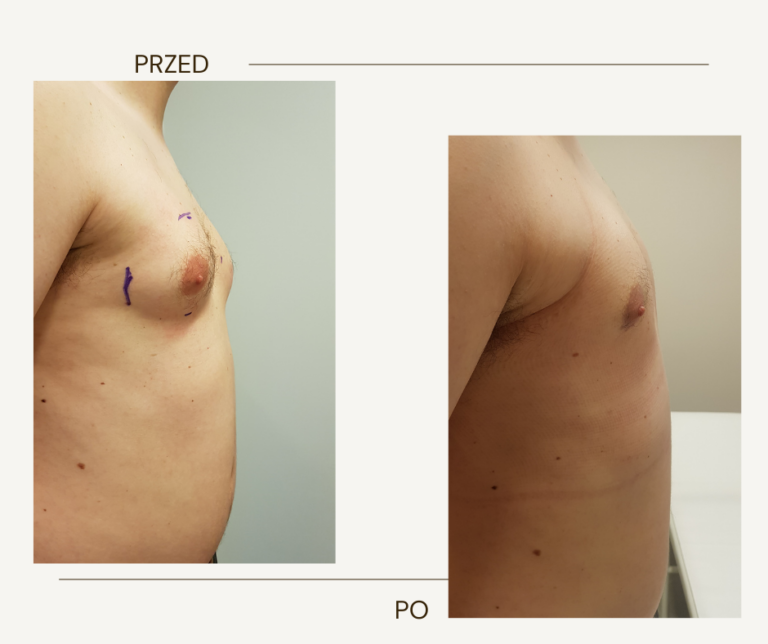 Usuwanie ginekomastii