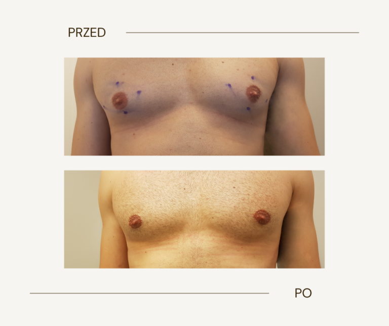 Usuwanie ginekomastii