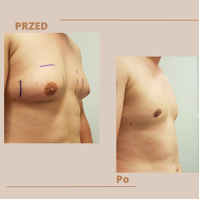 Usuwanie ginekomastii