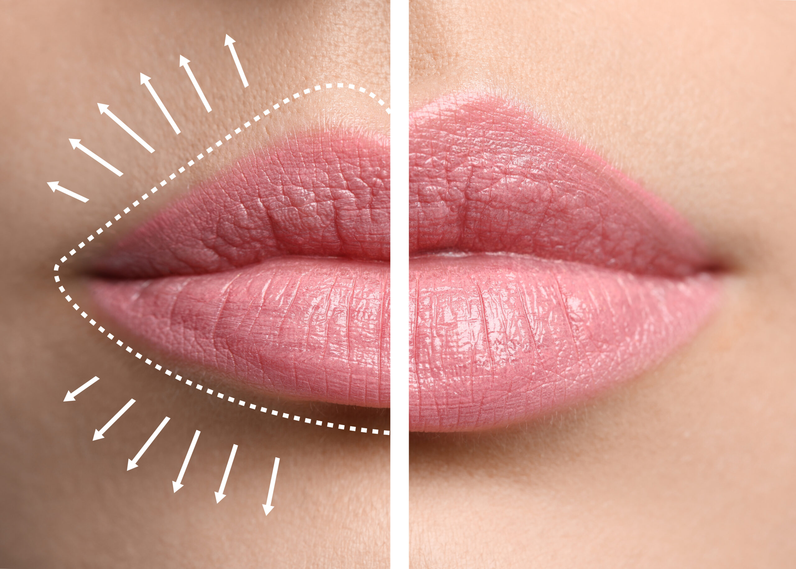 liplift Wilmed